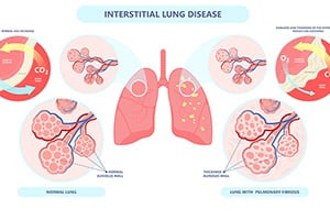 Symptoms of Asbestos Exposure